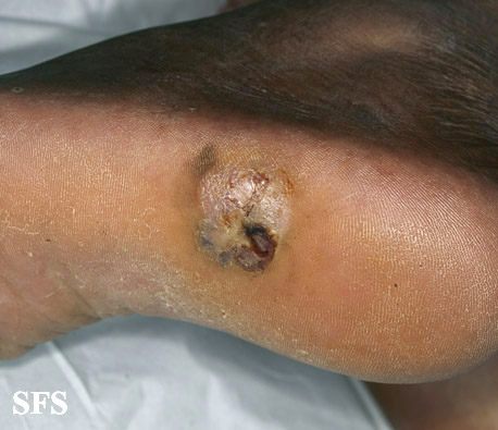 File:Melanoma (Dermatology Atlas 73).jpg