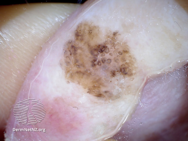 File:Melanoma in situ, nonpolarised dermoscopy view (DermNet NZ 20131127111916200).jpg