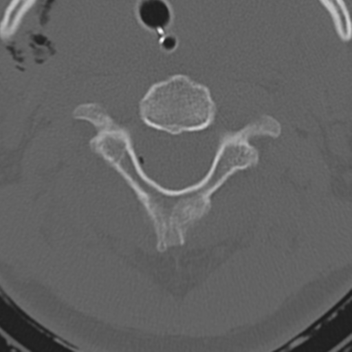 File:Multitrauma with diffuse axonal injury, temporal bone fractures and traumatic caroticocavernous fistula (Radiopaedia 37242-39035 Axial 201).png
