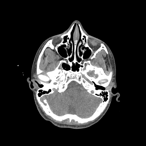 Nasal pyogenic granuloma (lobular capillary hemangioma) (Radiopaedia 85536-101244 Axial non-contrast 74).jpg