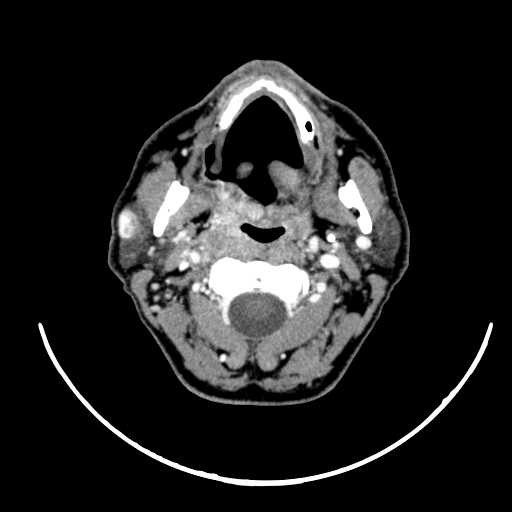 File:Nasopharyngeal carcinoma - infiltrating the clivus (Radiopaedia 62583-70875 Axial Post contrast 26).jpg