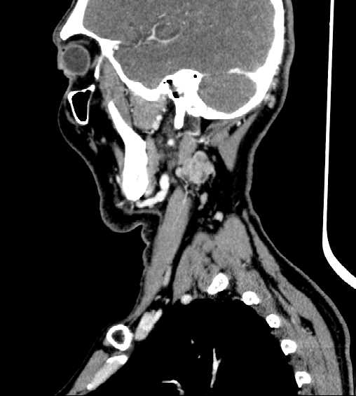 File:Nasopharyngeal carcinoma - infiltrating the clivus (Radiopaedia 62583-70875 C 41).jpg