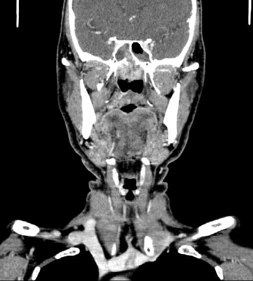 File:Nasopharyngeal carcinoma - infiltrating the clivus (Radiopaedia 62583-70875 D 16).jpg