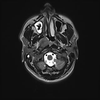 File:Nasopharyngeal carcinoma with perineural spread (Radiopaedia 55030-61380 Axial T2 29).jpg