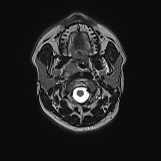 Nasopharyngeal carcinoma with perineural spread (Radiopaedia 55030-61380 Axial T2 32).jpg