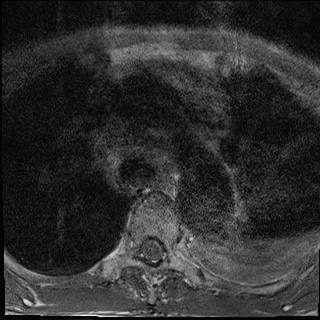 File:Nasopharyngeal carcinoma with skull base invasion (Radiopaedia 59258-66600 Axial T1 39).jpg