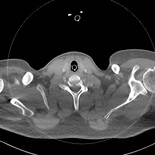 File:Neck CT angiogram (intraosseous vascular access) (Radiopaedia 55481-61945 B 136).jpg