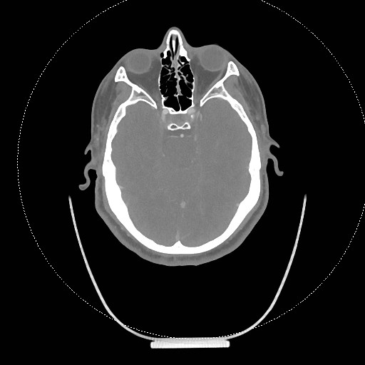 Neck CT angiogram (intraosseous vascular access) (Radiopaedia 55481-61945 B 289).jpg