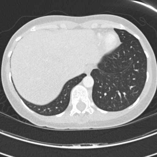 Necrobiotic pulmonary nodules - Crohn disease (Radiopaedia 20723-20631 Axial lung window 119).jpg