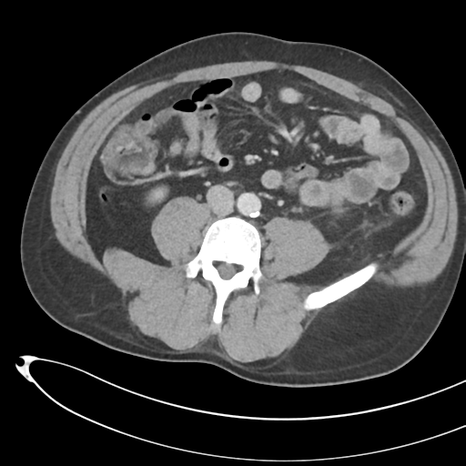 File:Necrotizing pancreatitis with acute necrotic collections (Radiopaedia 38829-41012 B 49).png