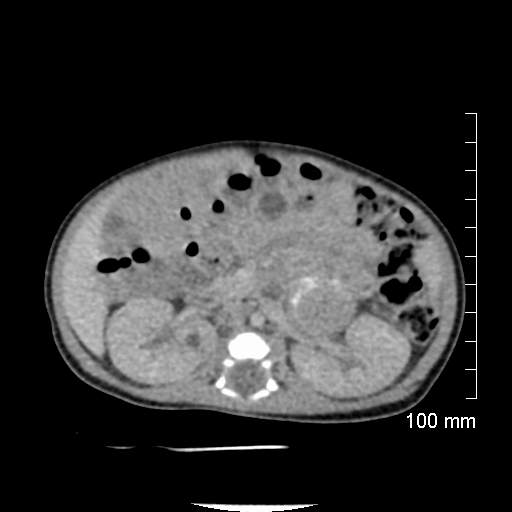 File:Neonatal neuroblastoma (Radiopaedia 56651-63438 Axial non-contrast 38).jpg