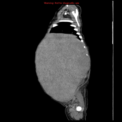 File:Neonatal neuroblastoma (Radiopaedia 9564-10223 C 33).jpg