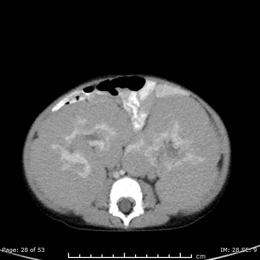 File:Nephroblastomatosis (Radiopaedia 41934-44935 A 28).jpg
