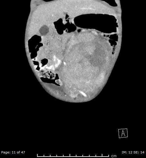 File:Neuroblastoma (Radiopaedia 41472-44355 B 11).jpg