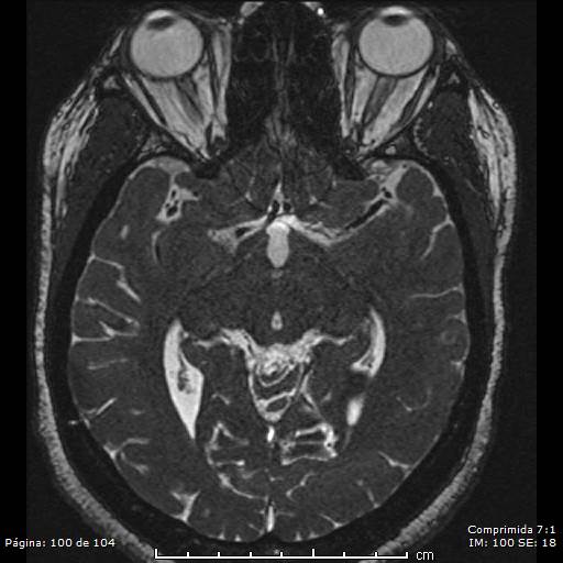 Neurocysticercosis (Radiopaedia 58636-65832 I 100).jpg