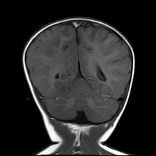 File:Neurofibromatosis type 1 (Radiopaedia 30089-30671 Coronal T1 22).jpg
