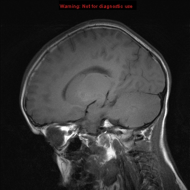 File:Neurofibromatosis type 1 with optic nerve glioma (Radiopaedia 16288-15965 Sagittal T1 15).jpg