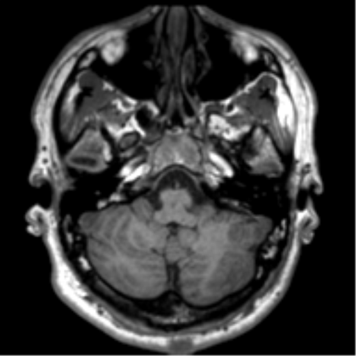 File:Neurofibromatosis type 2 (Radiopaedia 44936-48838 Axial T1 22).png
