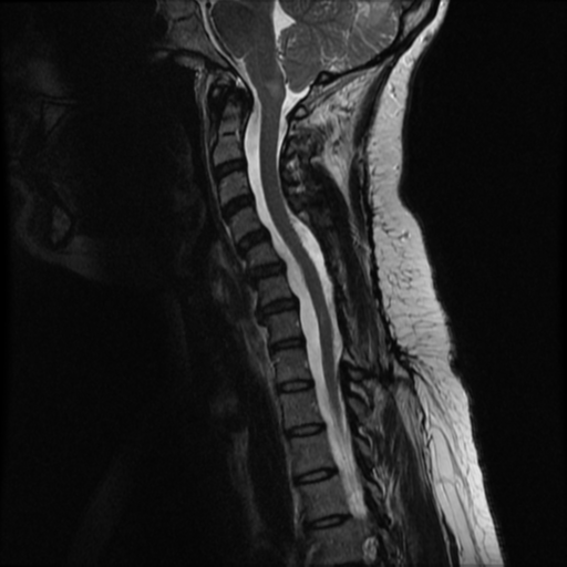 File:Neurofibromatosis type 2 (Radiopaedia 45229-49252 Sagittal T2 8).png