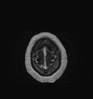 Neurofibromatosis type 2 (Radiopaedia 79097-92049 Axial T1 C+ 180).jpg