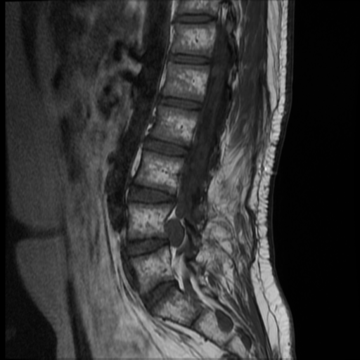 File:Neurofibromatosis type 2 (spinal manifestations) (Radiopaedia 53943-60070 F 6).png
