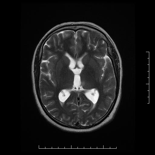 File:Neuroglial cyst of brainstem (Radiopaedia 29134-29526 Axial T2 11).jpg