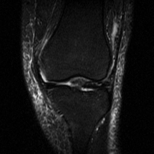 File:Non-displaced patella fracture (Radiopaedia 15932-15582 Coronal STIR 10).jpg