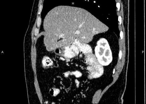 Non-syndromic pancreatic endocrine tumor (Radiopaedia 86958-103178 E 28).jpg