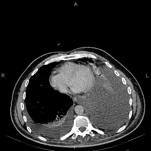 Non Hodgkin lymphoma in a patient with ankylosing spondylitis (Radiopaedia 84323-99621 Axial C+ delayed 2).jpg