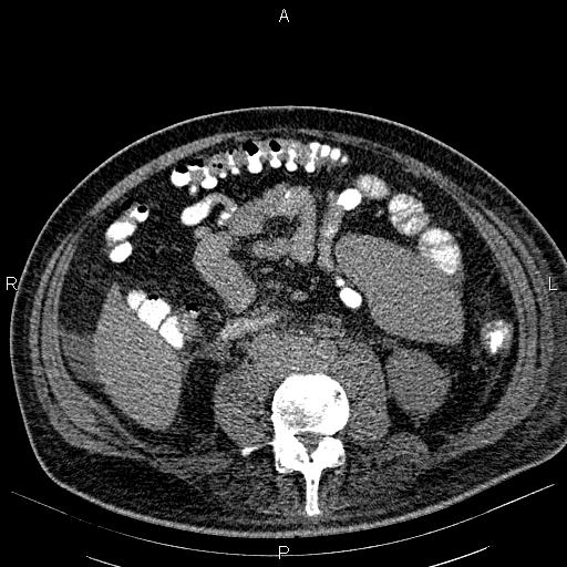File:Non Hodgkin lymphoma in a patient with ankylosing spondylitis (Radiopaedia 84323-99621 Axial non-contrast 41).jpg