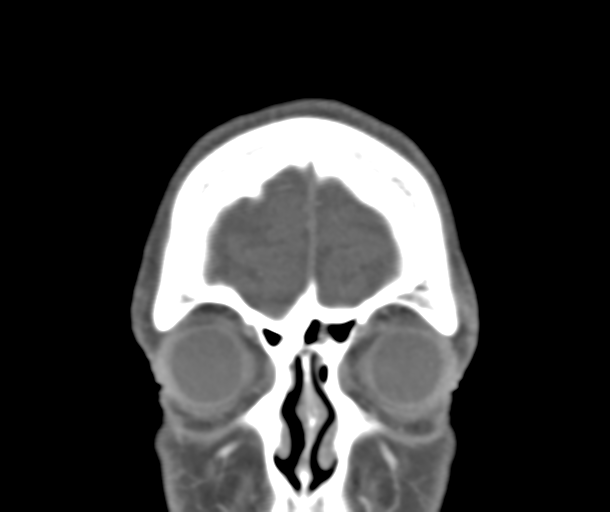 File:Normal CTA head (Radiopaedia 40801-43464 B 14).png