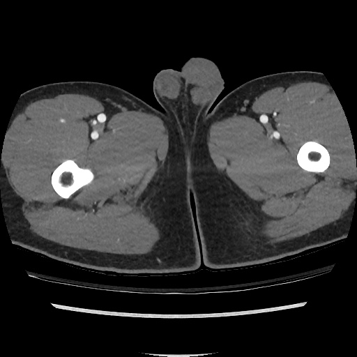 File:Normal CT angiogram of pelvis (Radiopaedia 45390-49430 A 64).jpg
