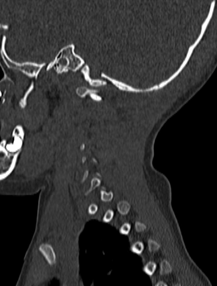 File:Normal CT cervical spine - pediatric (Radiopaedia 52549-58462 Sagittal bone window 18).jpg