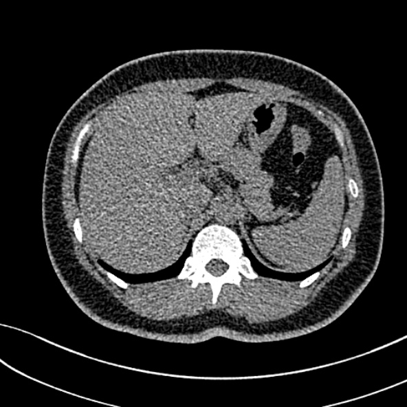 Normal CT chest- adult female (Radiopaedia 52522-58428 Axial non-contrast 128).jpg