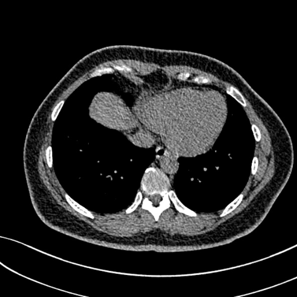 Normal CT chest- adult female (Radiopaedia 52522-58428 Axial non-contrast 95).jpg