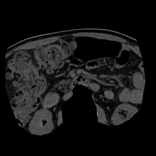 File:Normal CT intravenous cholangiogram (Radiopaedia 38199-40208 Axial IVC (MIP) 4).png