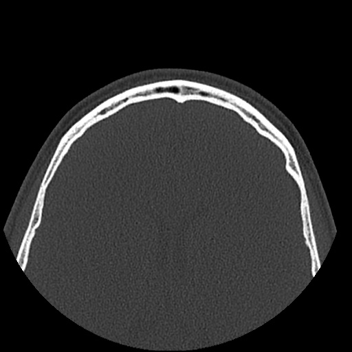 Normal CT paranasal sinuses (Radiopaedia 42286-45390 Axial bone window 10).jpg