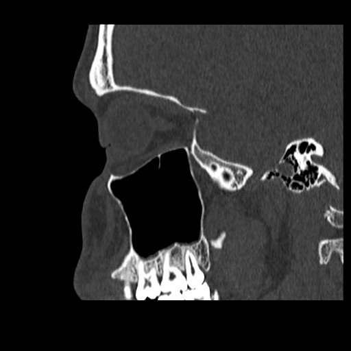 Normal CT paranasal sinuses (Radiopaedia 42286-45390 Sagittal bone window 26).jpg