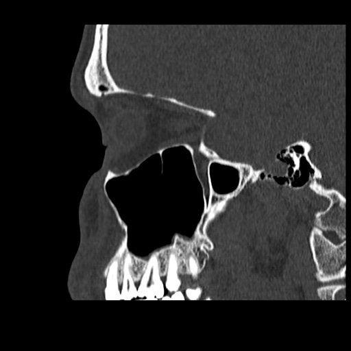 Normal CT paranasal sinuses (Radiopaedia 42286-45390 Sagittal bone window 30).jpg