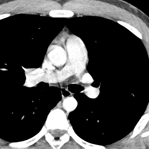 File:Normal CT pulmonary veins (pre RF ablation) (Radiopaedia 41748-44702 A 87).png