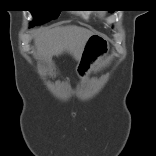 File:Normal CT renal artery angiogram (Radiopaedia 38727-40889 B 11).png
