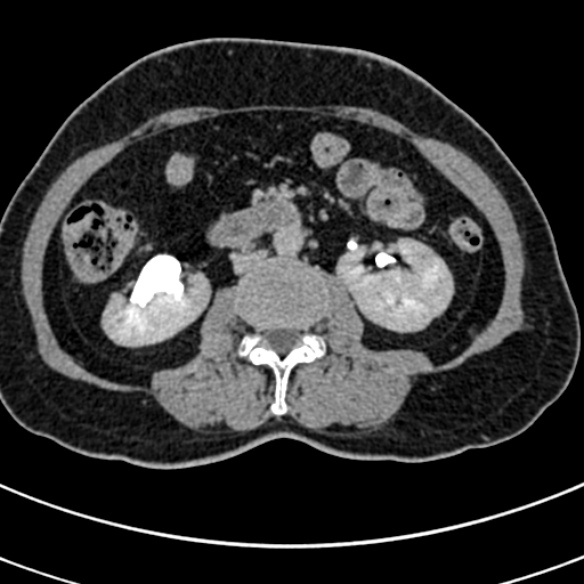 File:Normal CT split bolus study of the renal tract (Radiopaedia 48631-53634 Axial split bolus 111).jpg