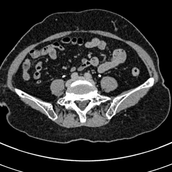 File:Normal CT split bolus study of the renal tract (Radiopaedia 48631-53634 Axial split bolus 188).jpg