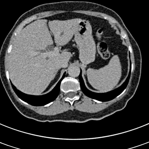 File:Normal CT split bolus study of the renal tract (Radiopaedia 48631-53634 Axial split bolus 3).jpg