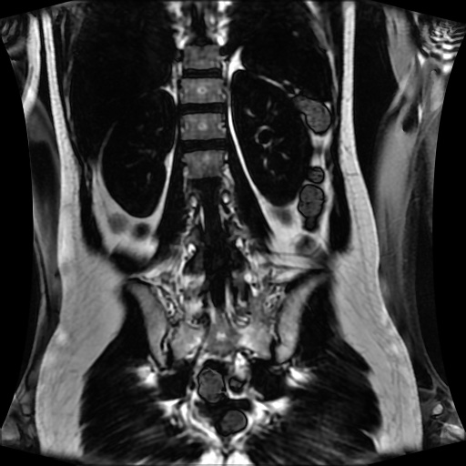 Normal MRI abdomen in pregnancy (Radiopaedia 88001-104541 N 100).jpg