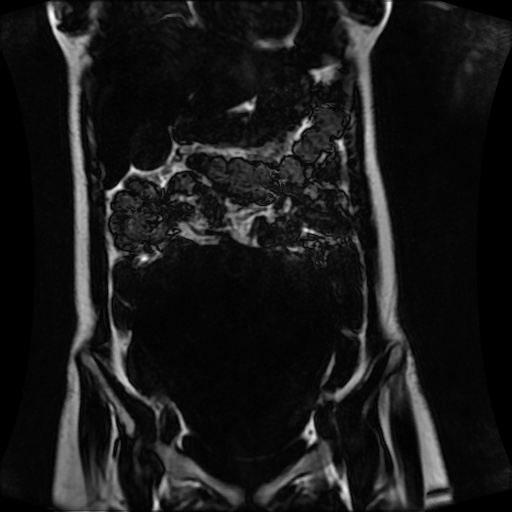 Normal MRI abdomen in pregnancy (Radiopaedia 88001-104541 N 53).jpg