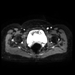 Normal MRI abdomen in pregnancy (Radiopaedia 88005-104548 Axial DWI 11).jpg
