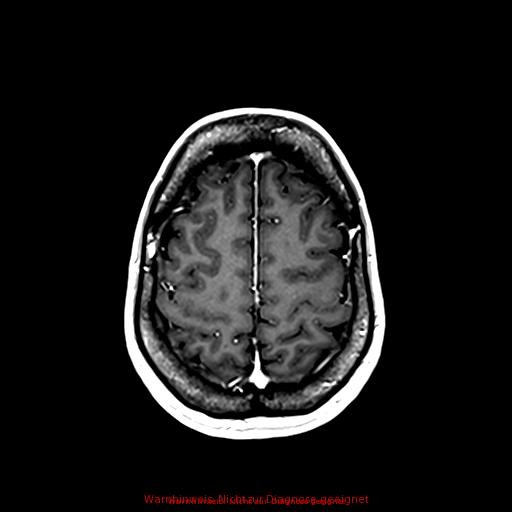 Normal adult brain MRI (non-enhanced and contrast-enhanced) (Radiopaedia 75262-86379 Axial T1 C+ 148).jpg