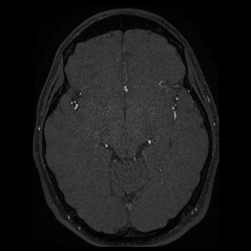 Normal brain MRA (Radiopaedia 41046-43793 Axial MRA 43).png
