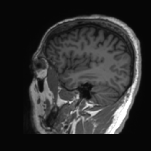 Normal brain MRI (non-focal epilepsy protocol) (Radiopaedia 53917-60040 Sagittal T1 54).png